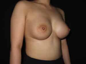 Breast Augmentation